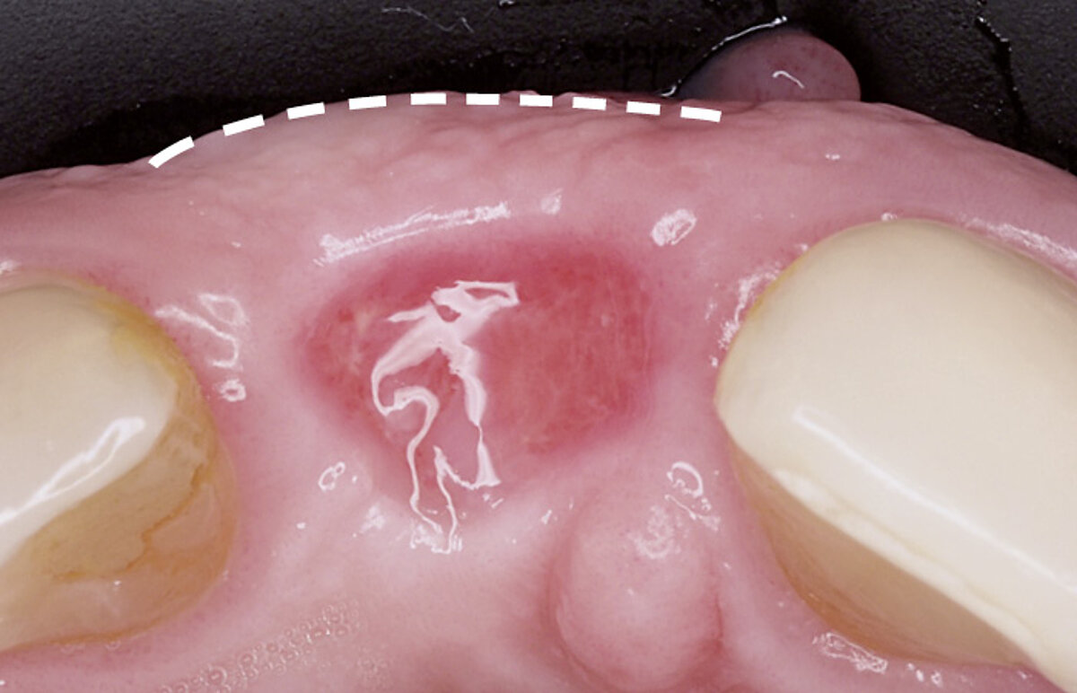 Extraction dentaire – Traitement pour préserver l'alvéole © 